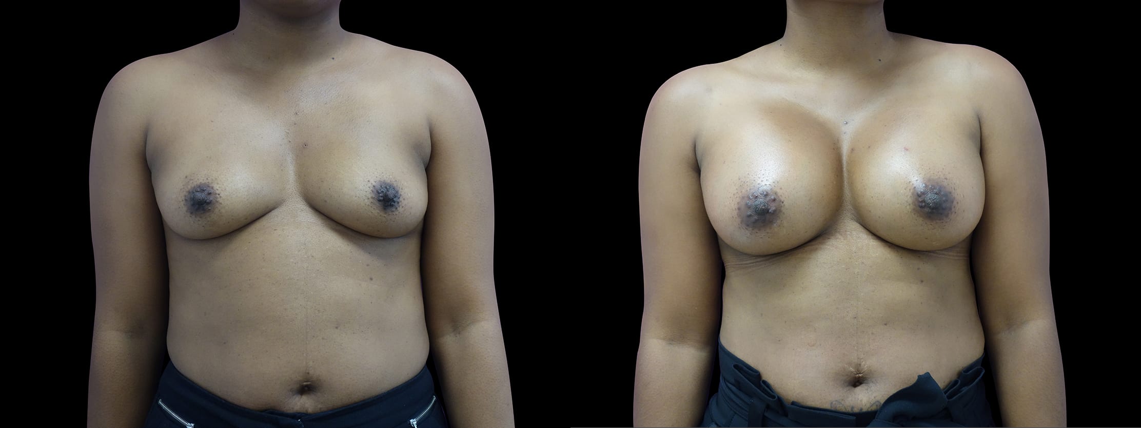 Procedure: Breast Augmentation with 475 CC silicone implants; High Profile....