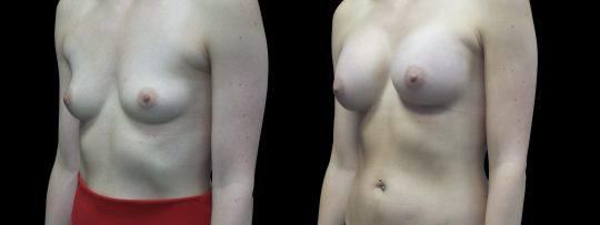 Case #114 Breast augmentation