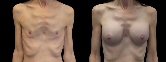 front view of a female patient before and after Breast augmentation