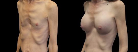 Case #115 Breast augmentation