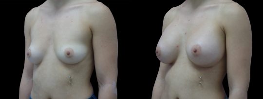 Case #117 Breast augmentation