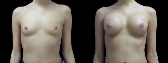 Case #118 Breast augmentation