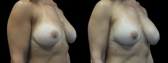 Case #158 Breast Augmentation