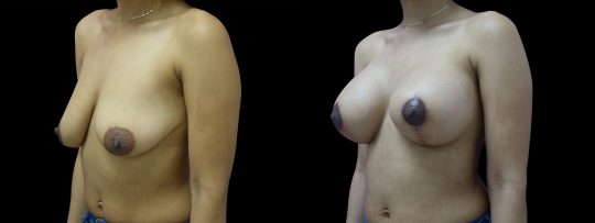 Case #156 Breast Lift and Augmentation