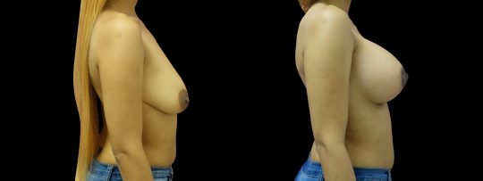 Case #156 Breast Lift and Augmentation