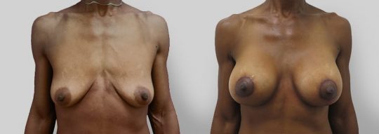 Case #13 Breast Augmentation