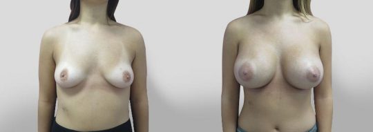front view of a female patient before and after Breast Augmentation