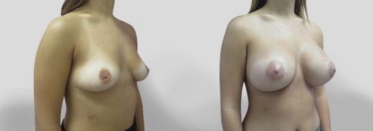 Case #30 Breast Augmentation
