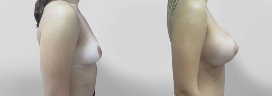 side view of a female patient before and after Breast Augmentation