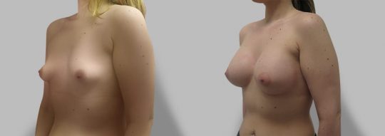 Case #80 Breast augmentation