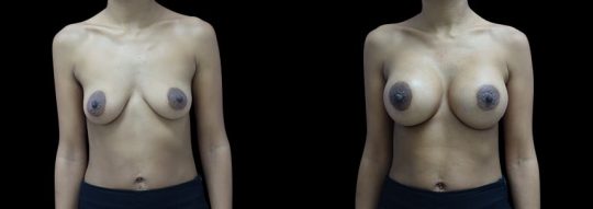 Case #91 Breast augmentation