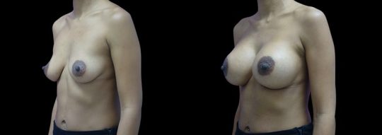 Case #91 Breast augmentation