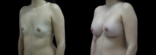 Case #93 Breast augmentation