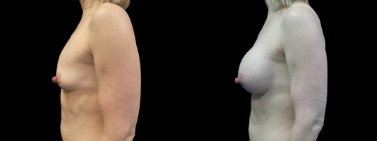 Case #170 Breast Augmentation