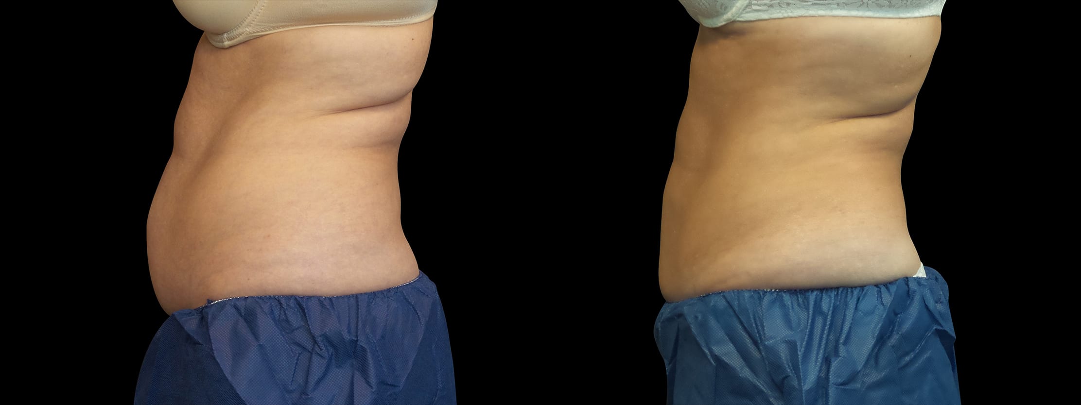 CoolSculpting® Upper Flanks