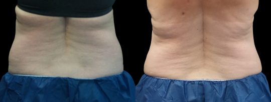 Case #173 CoolSculpting flanks and abdomen