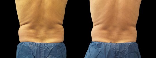male patient's back before and after CoolSculpting treatment of lower flanks