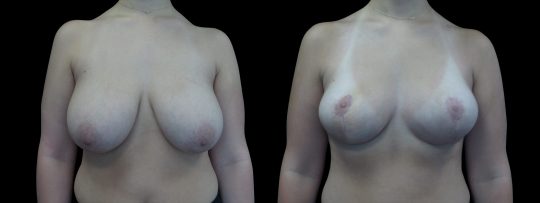 Case #179 Breast Reduction