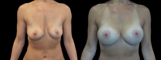 Case #160 Breast augmentation