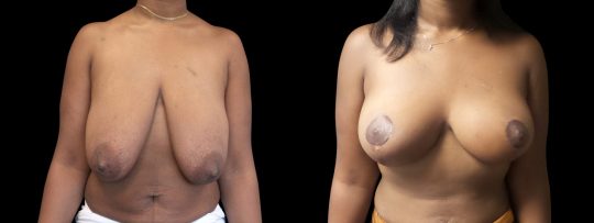 Case #181 Breast Lift