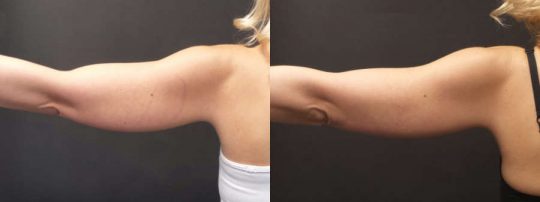 Female patient's arm before and after EmSculpt treatment