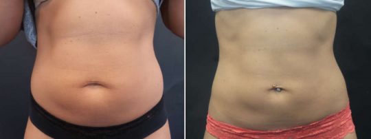 Female patient's abdomen before and after EmSculpt treatment