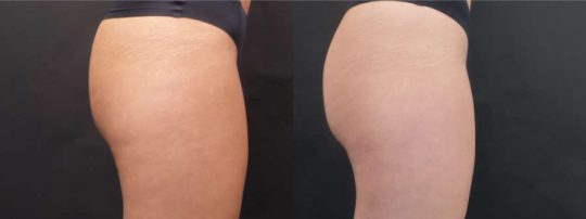 Side view of Female patient's buttocks before and after EmSculpt treatment