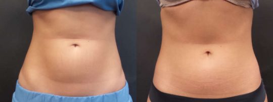 Front view of Female patient's abdomen before and after EmSculpt treatment
