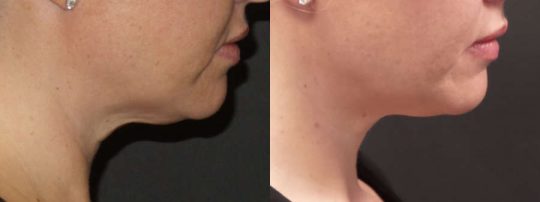 side view of a female patient before and after Face accutite treatment