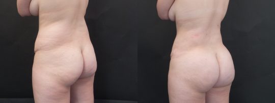 female patient before and after Buttock Augmentation (Brazilian Butt Lift)