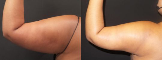arms before and after