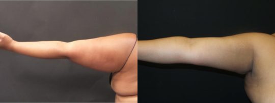 arms before and after