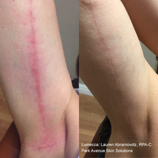 NYC Midtown Scar Treatment, Therapy, Long Island Scar Removal