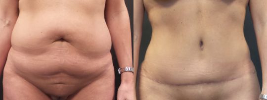 Case #89 Tummy Tuck before and after.