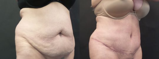 Case#1913 Tummy Tuck with liposuction to abdomen and flanks