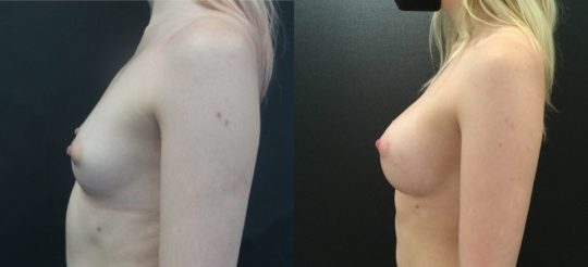 Case #141 6 months post breast augmentation with Mentor 425HP silicone (submuscular)