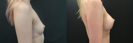 Case #141 6 months post breast augmentation with Mentor 425HP silicone (submuscular)