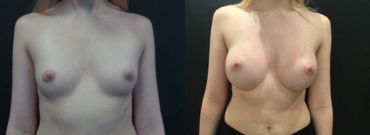 front view of a female patient before and 6 months after breast augmentation