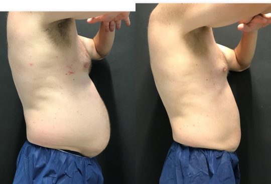 side view of a male patient before and 6 weeks after CoolSculpting to Abdomen and Flanks