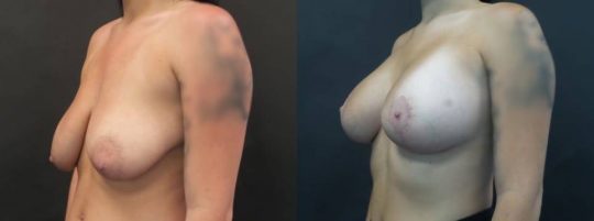 20 yo F 3 months post breast lift with aug, sientra 385MP R, 415MPL submuscular