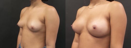 side view of a female patient before and 3 months after breast augmentation