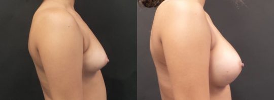 side view of a female patient before and 3 months after breast augmentation