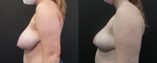 24 yo F 3 months post breast reduction