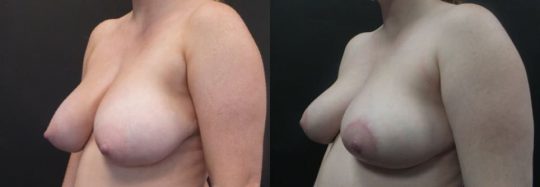 side view of a female patient before and 3 months after breast reduction