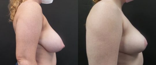 side view of a female patient before and 3 months after breast reduction