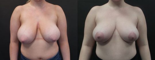 24 yo F 3 months post breast reduction
