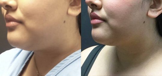 left profile of a female patient's lower face before and after local submental lipo with facetite and morpheus