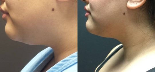 25 yo F 3 mos post local submental lipo with facetite and morpheus