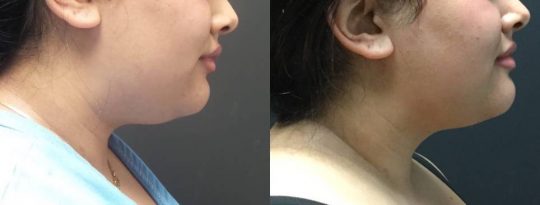 side view of a female patient's lower face before and after local submental lipo with facetite and morpheus