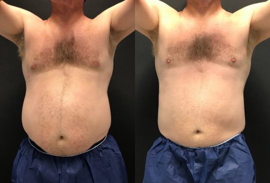 front view of a male patient before and 6 weeks after CoolSculpting to Abdomen and Flanks